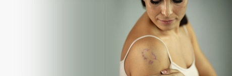 Подкожная гематома на плече