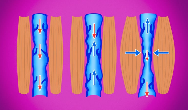 Изображение венозной недостаточности, иллюстрирующее нарушение компрессии и дальнейшую потерю эластичности вен, препятствующие циркуляции крови