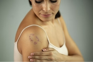 Подкожная гематома бурого цвета