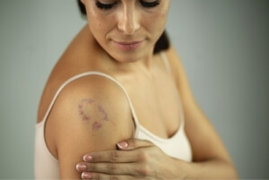 Подкожная гематома бурого цвета