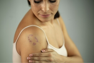 Подкожная гематома бурого цвета